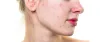  Best Anti-Wrinkle Injection Treatment in Malviya Nagar South Delhi. Dr. Hiranmayi Jha