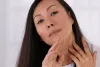 Acne Scars: Is There a Way to Remove Them Completely?