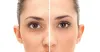Anti Acne Treatment