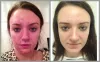 acne-treatment-n-lite-laser-before-after-results-the-private-clinic.jpg