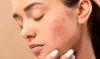 Acne Treatments Niagara