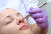 Ways to Choose Effective Acne Scar Treatment 