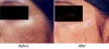 Acne scar removal treatment - Pimple Scar Removal Delhi