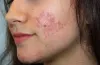 "Radiant Skin Secrets: Unveiling the Best Actinic Keratosis Treatment in Dubai!"
