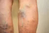 Spider and Varicose Vein Treatment Clinic: Introduction To Spider Vein Disease: Symptoms And Treatment