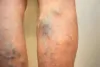 Get Rid Of Varicose Veins