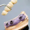 Dental Implant Removal | Dealing With Dental Implant Failures