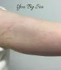 Stretch Marks Removal Treatment | You By Sia