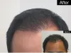 Hair Restoration Raleigh NC | Hair Transplant Surgeon NC