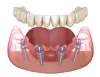    The Teeth-in-a Day System. Get Your Perfect Smile in One Visit - Top.me 
