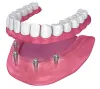 All-on-4 Implants Hackensack, NJ | Gentle Dental Service | Teeth in a Day