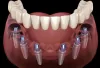 Dental Implants in Gurgaon | Cost of Dental Implants in Gurgaon