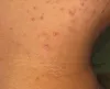 Bed Bug Pest Control Singapore | Bed Bugs Removal Singapore