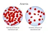 Ayurvedic treatment for Anemia | Kidney And Ayurveda