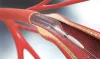 primary angioplasty
