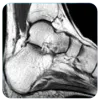  Foot and ankle surgeon in Mumbai | Dr. Pranjal Kodkani 