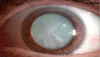 Cataract treatment in Mumbai |1 M+ surgeries | Rushabh Eye