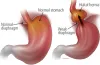 Laparoscopic Anti Reflux Surgery at Indore-Laparoscopy-Center