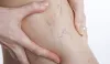 What are the causes of chronic venous insufficiency and possible treatments?