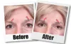 Blepharoplasty In Seattle &amp; Tacoma | Eyelid Surgery Seattle