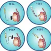 tesa treatment in delhi
