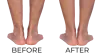 Escape Suffering From Varicose Veins