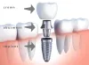 Dental Implant Cost in Gurgaon