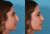 Nose Reshaping Rhinoplasty Toronto