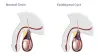 Epididymal Cyst Treatment in Ayurveda