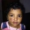 Padanjali - Keloids, Keloid Treatment, Burns, Burn Scars, Diabetic Wounds, White scars, Psoriasis, Eczema, Leukoderma, Vitiligo: Herbal/Alternative Treatment - Padanjali Ayurvedics