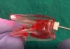ROOT CANAL DISINFECTION IN PERMANENT TOOTH USING LASER DURING ROOT CANAL PROCEDURE/ENDODONTIC TREATM