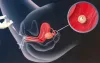 iui treatment in delhi