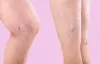 Top Varicose Veins Surgeon :: veintreatmentclinic