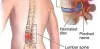 Back Surgery: Pros and Cons
