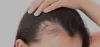 Hair Weaving in Chennai, services, system, treatment