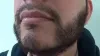 Beard Hair Transplant