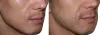 Beard Transplantation in Tirupati - Dr.Sajjas.in 