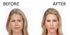 Botox Injection Suffolk VA