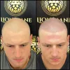 Scalp Micropigmentation Melbourne | SMP Clinic | Hair Tattoo Treatment