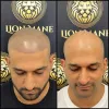 Behind the Cost of Scalp Micro Pigmentation - Daily Business Post