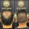 Scalp Micropigmentation Melbourne | SMP Clinic | Hair Tattoo Treatment