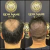 Combining Hair Transplant and Scalp MicroPigmentation