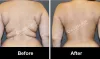  Liposuction Surgery in Delhi | Liposuction & Body Contouring 