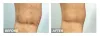 What are the best Spider and Varicose Vein Treatment Options? | A guide by our Harvard Trained Vein Doctors