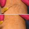 paindoctorclifton [licensed for non-commercial use only] / varicose-veins-pain-relief