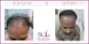 FUT Treatment in Delhi or Follicular unit Transplant by Satya Hair Clinic