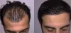 FUE Hair Transplant in Dubai, Abu Dhabi, UAE - Hair Transplant Center