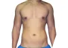 Vaser Liposuction Before and After Photos | Premiere Surgical Arts
