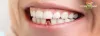 Benefits of Dental Implants and the Best Place for It - Cosmodent