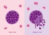 Malignant Rhabdoid Tumor